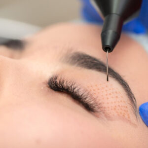 Biefaroplastía láser superior-100