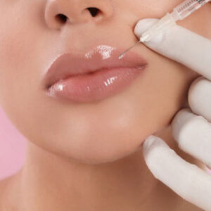 Relleno de labios con Ácido Hialurónico